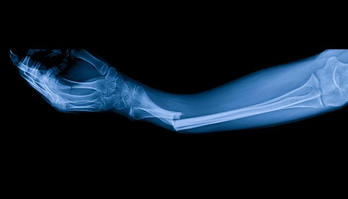 Chinese Scientists Develop ‘Bone Glue’ That Heals Fractures in Just 3 Minutes