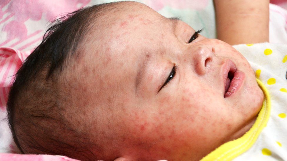Measles outbreak Kasur