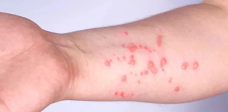 mpox cases in Sindh 2026